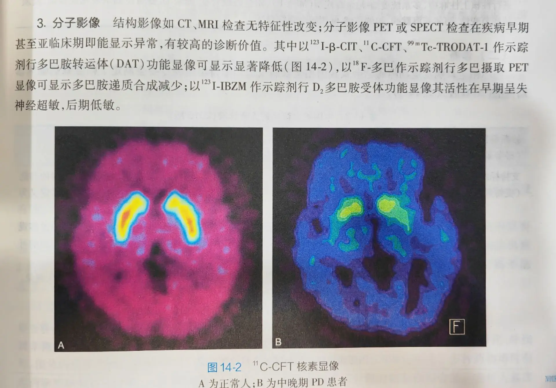帕金森PET-CT.