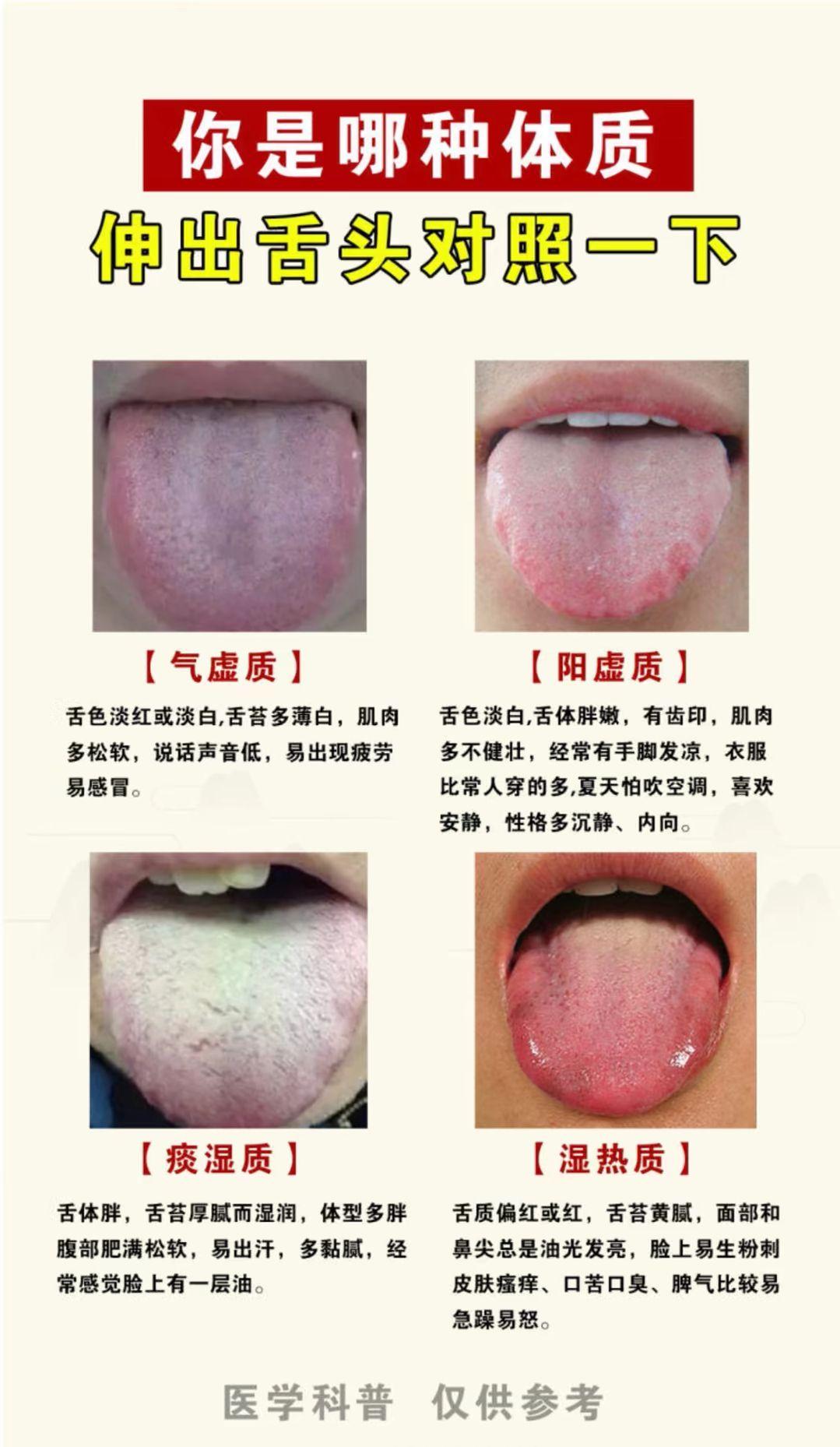 你是哪种体质 伸开你的舌头对照一下