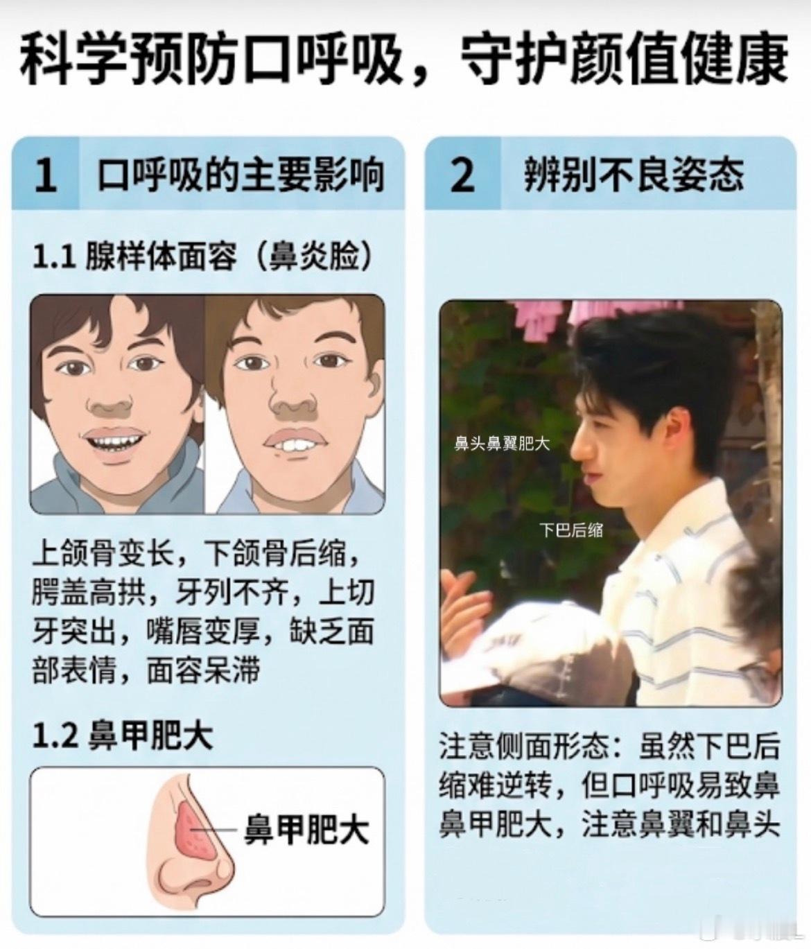 科普时间：口呼吸不只会造成下巴后//缩，还会造成鼻甲fei//大，大家一定要特别