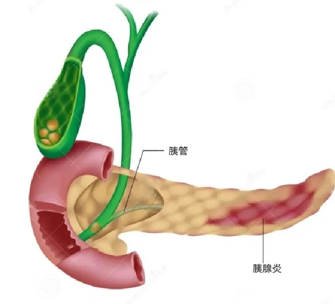 慢性胰腺炎的主胰管多宽定义为扩张？