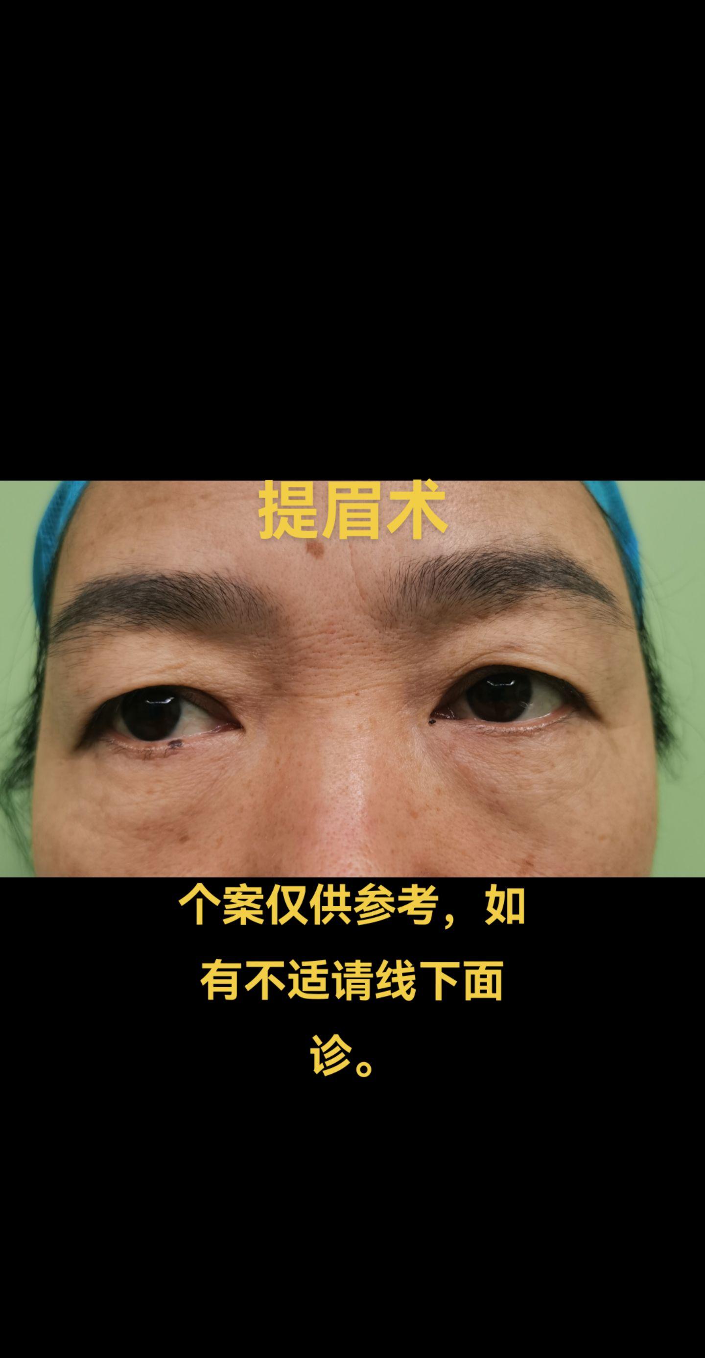 提眉术。提眉术，是一种较为常见的美容手术，是通过手术的方法切除眉上或眉...