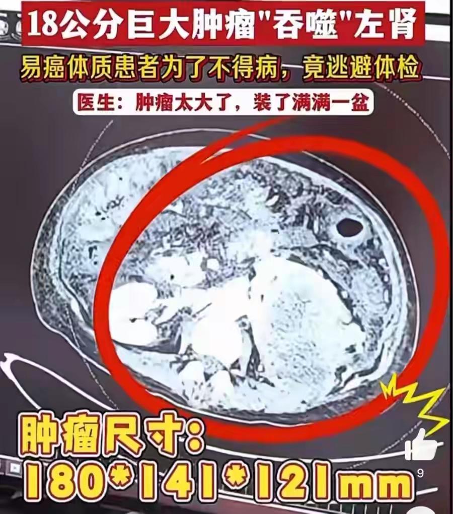 不检查我就没病！女子3次逃避体检左肾长出18厘米肿瘤。这句话听起来似乎轻描淡写，