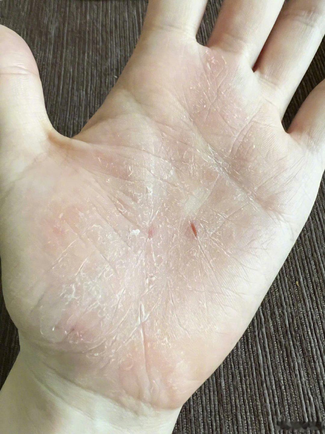张靓颖伸个懒腰右手掌就流血了张靓颖谁会伸个懒腰手掌就流血了 张靓颖这波分享太走心