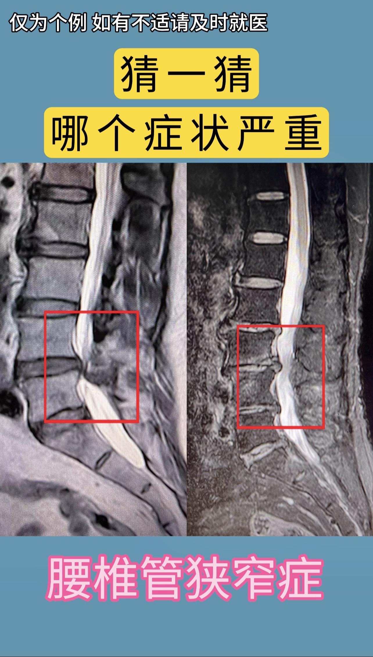 同样是60多岁男性，腰椎管狭窄，片子上看着病人情况轻，但症状很重，保守...