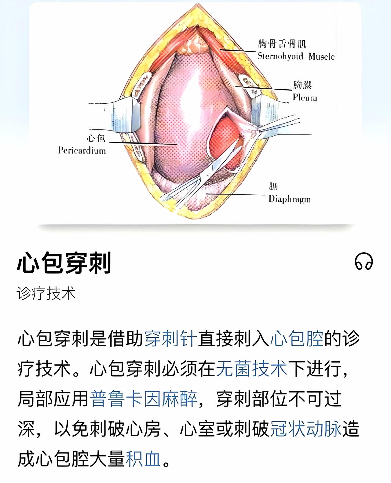 【一天一手术】心包穿刺术
手术名称：心包穿刺术，也可以称心包腔穿刺术‌或‌心包穿
