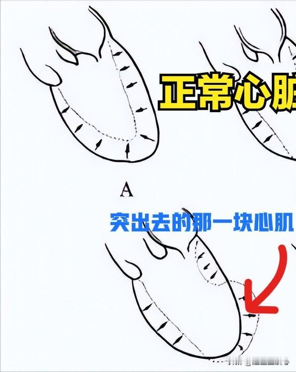 心脏室壁瘤是心脏长肿瘤吗？前几天门诊时候碰到一个68岁女性患者，因为胸痛一次到医