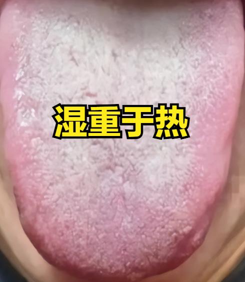 湿热分三种：湿重于热，热重于湿，湿热并重，调理方法大不同!

一，湿重于热
辨证