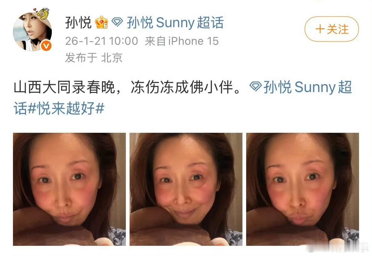 孙悦录春晚脸被冻伤 也难怪孙悦录春晚脸被冻伤，大同最低气温有零下20度。。。大家