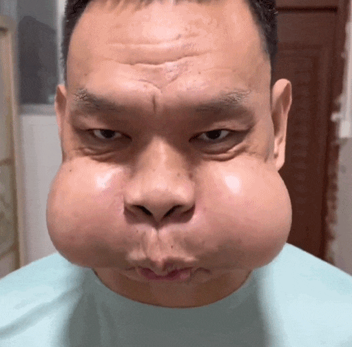 工作30年，男子面部严重变形，这些都是职业病

最近，广东一名从事吹玻璃工作长达