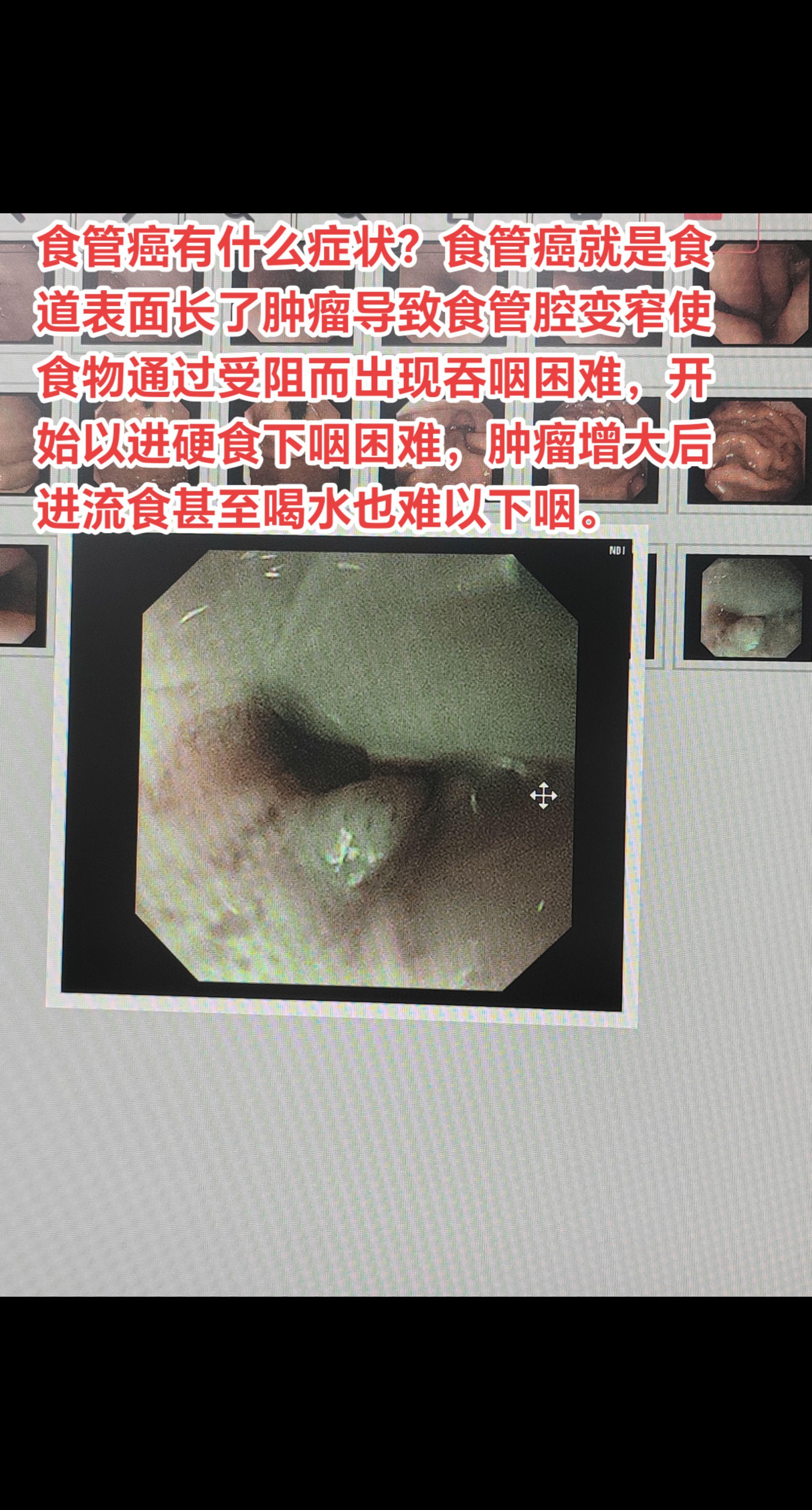食管癌有什么症状？ 食管癌就是食道表面长了肿瘤导致食管腔变窄使食物通过...