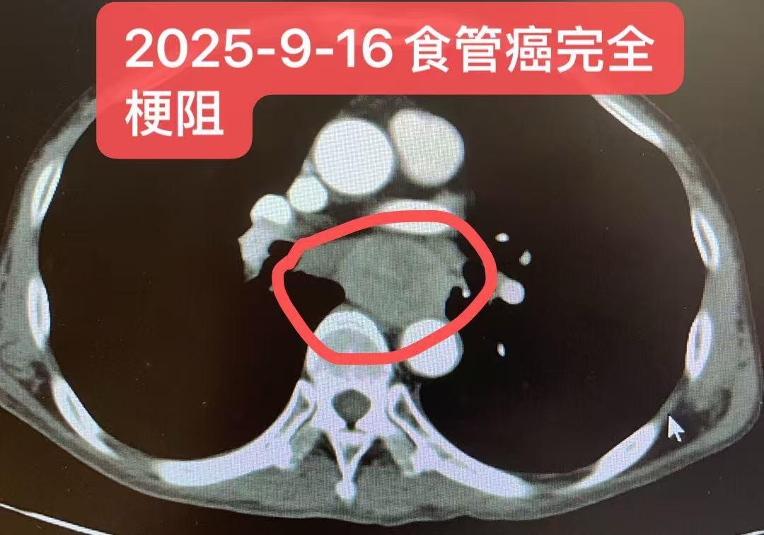 一例晚期食管癌的转化治疗。患者，男，57岁，食管鳞状细胞癌（距门齿20...