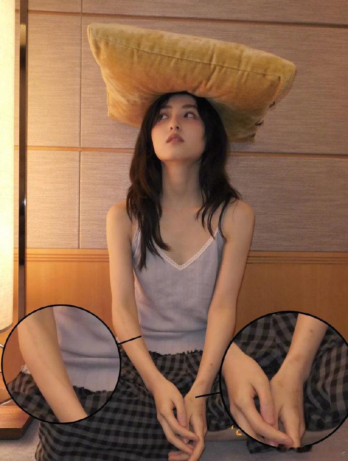 张子枫手臂都是伤疤 张子枫以往拍动作片都没怎么受伤，这次却遭遇大伤还留疤了，真让