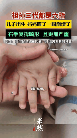 “担心的事情还是发生了！”9月，浙江杭州，一28岁女子因遗传到父亲的六指，从小就