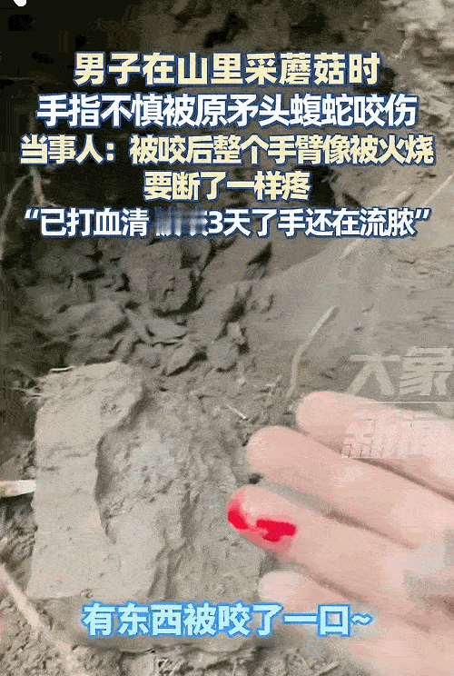 “悲剧还是发生了！”四川自贡，一男子在山里掏蘑菇时，手刚伸进去就被原矛头蝮蛇咬伤