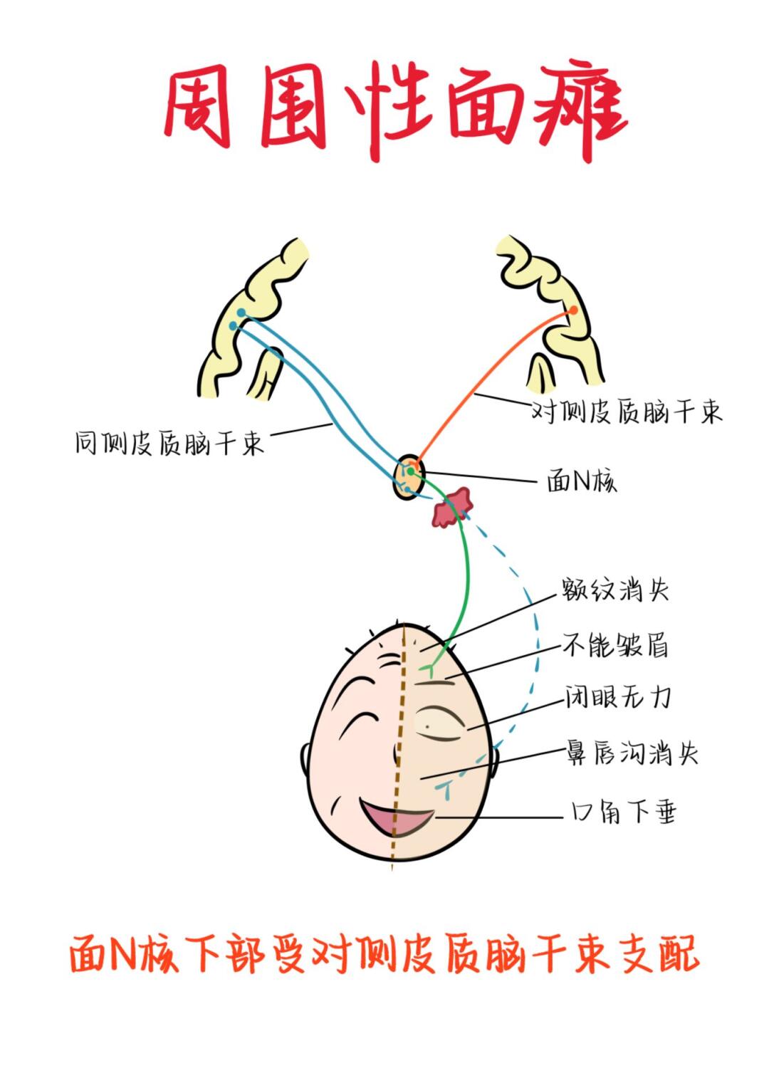 医学生笔记——周围性面瘫