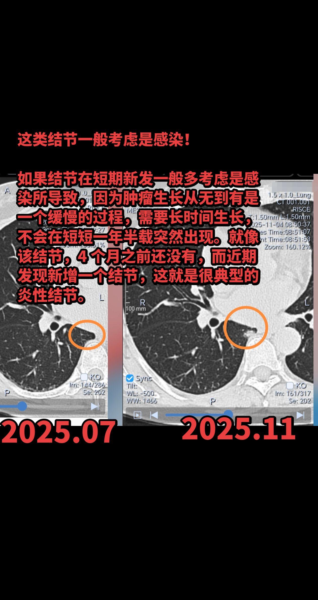这类结节一般考虑是感染！如果结节在短期新发一般多考虑是感染所导致，因为...