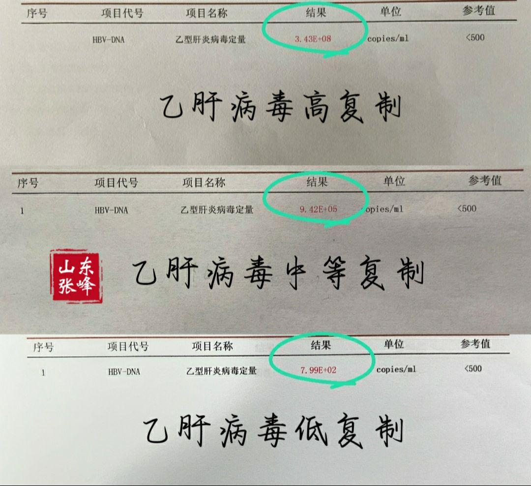 乙肝病毒量怎么看？10的3次方以下属于低病毒状态； 3次方到5次方属于...