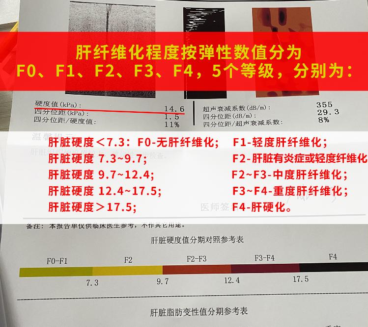 想知道自己有没有肝硬化，记住这4组数字。1.肝脏弹性测定：检测值在7....