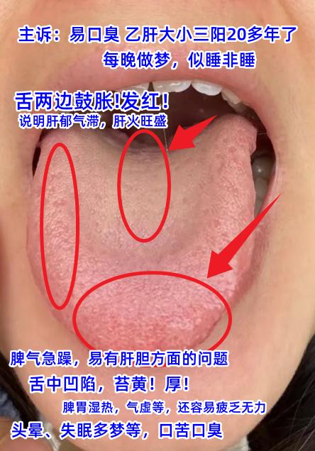 今日舌诊案例分享：阳虚寒湿、肝血不足、湿热下注、寒湿困腰[谢谢][谢谢][谢谢]