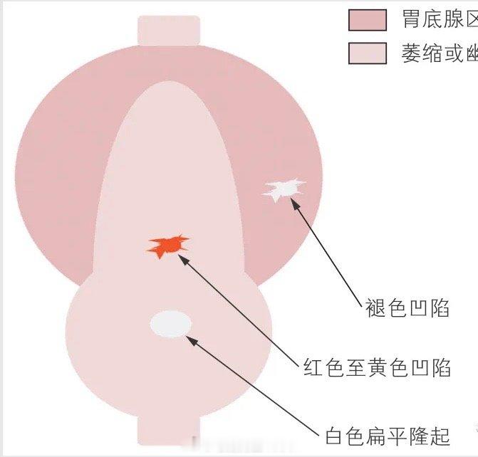 我们医联体的一位主任，萎缩性胃炎c3，im1，我给其做了两次胃镜，都没有什么变化