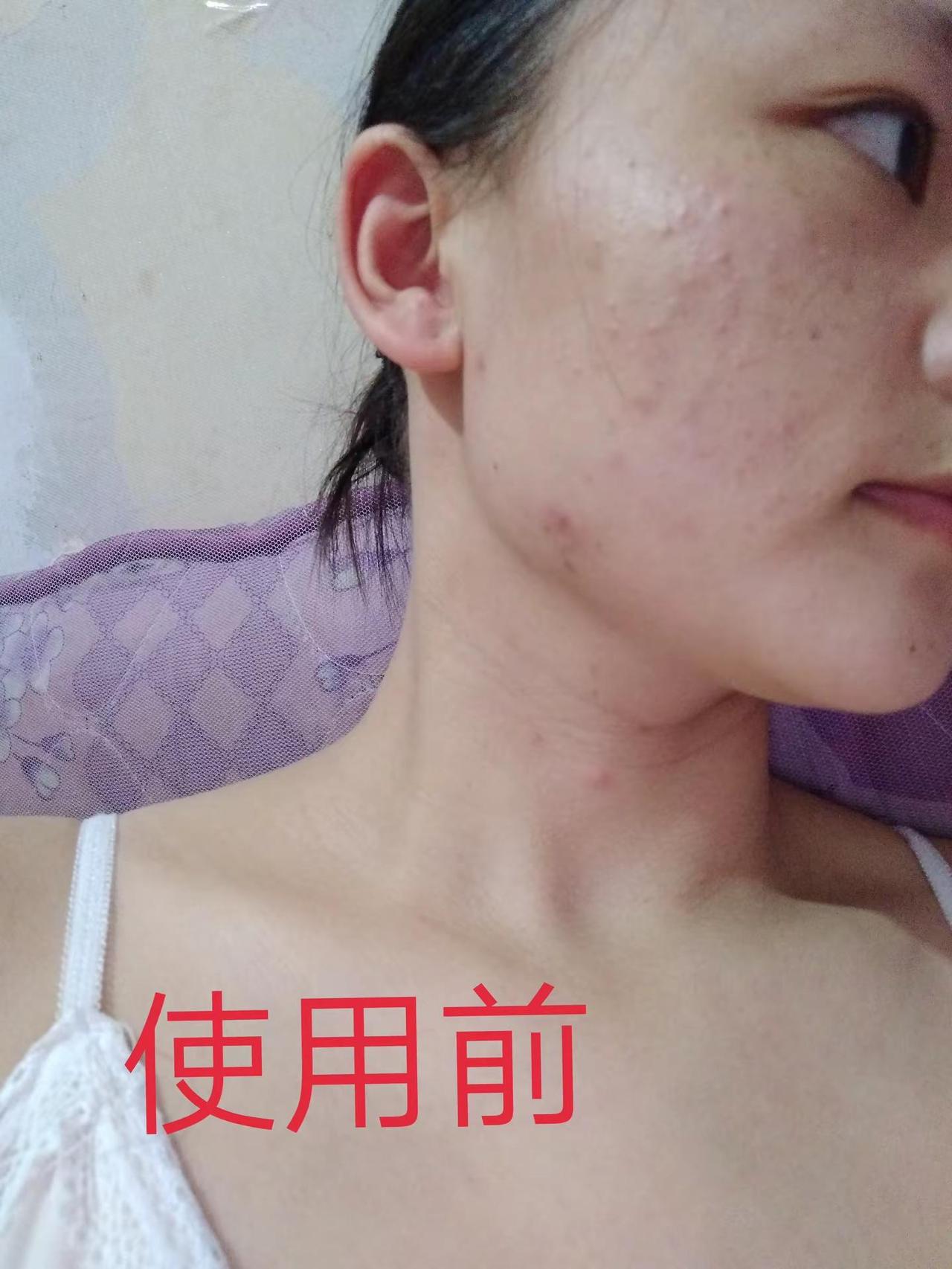 这是我来时的路被痘痘困扰的感觉只有自已懂，庆幸的是我买药膏擦，让我没变成一张激素