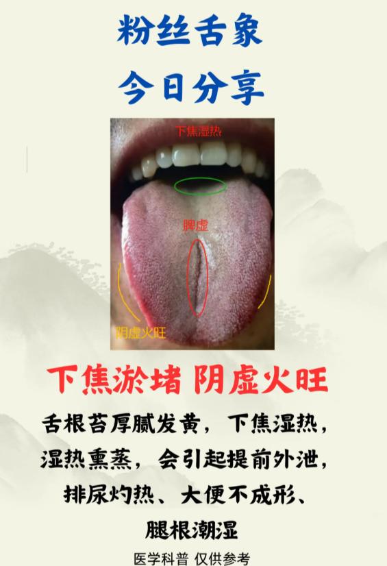 3 种舌象辨证：湿热、肝郁、血瘀调理法