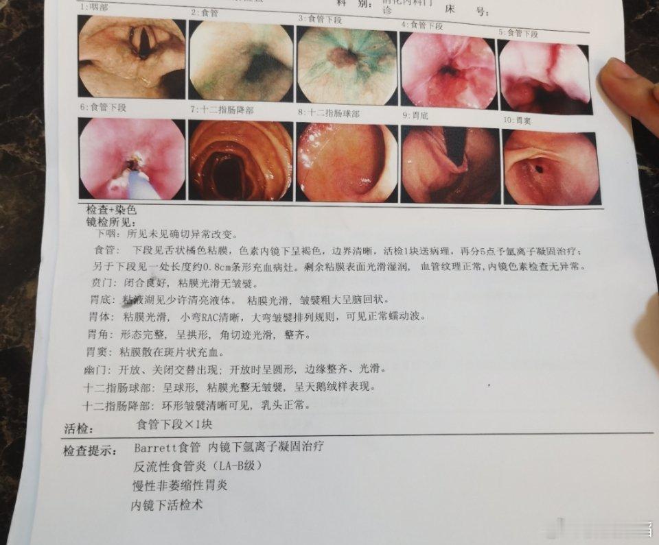 巴雷特食管（Barrett's esophagus）是指食管下段的复层鳞状上皮被