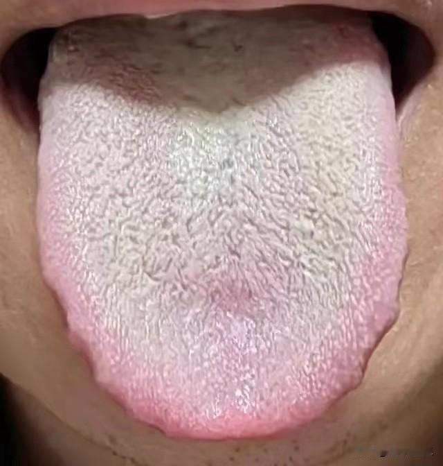 有这个舌象的男性朋友要警惕了

这个小伙子，刚开始看面相以为他五十岁了，没想到才