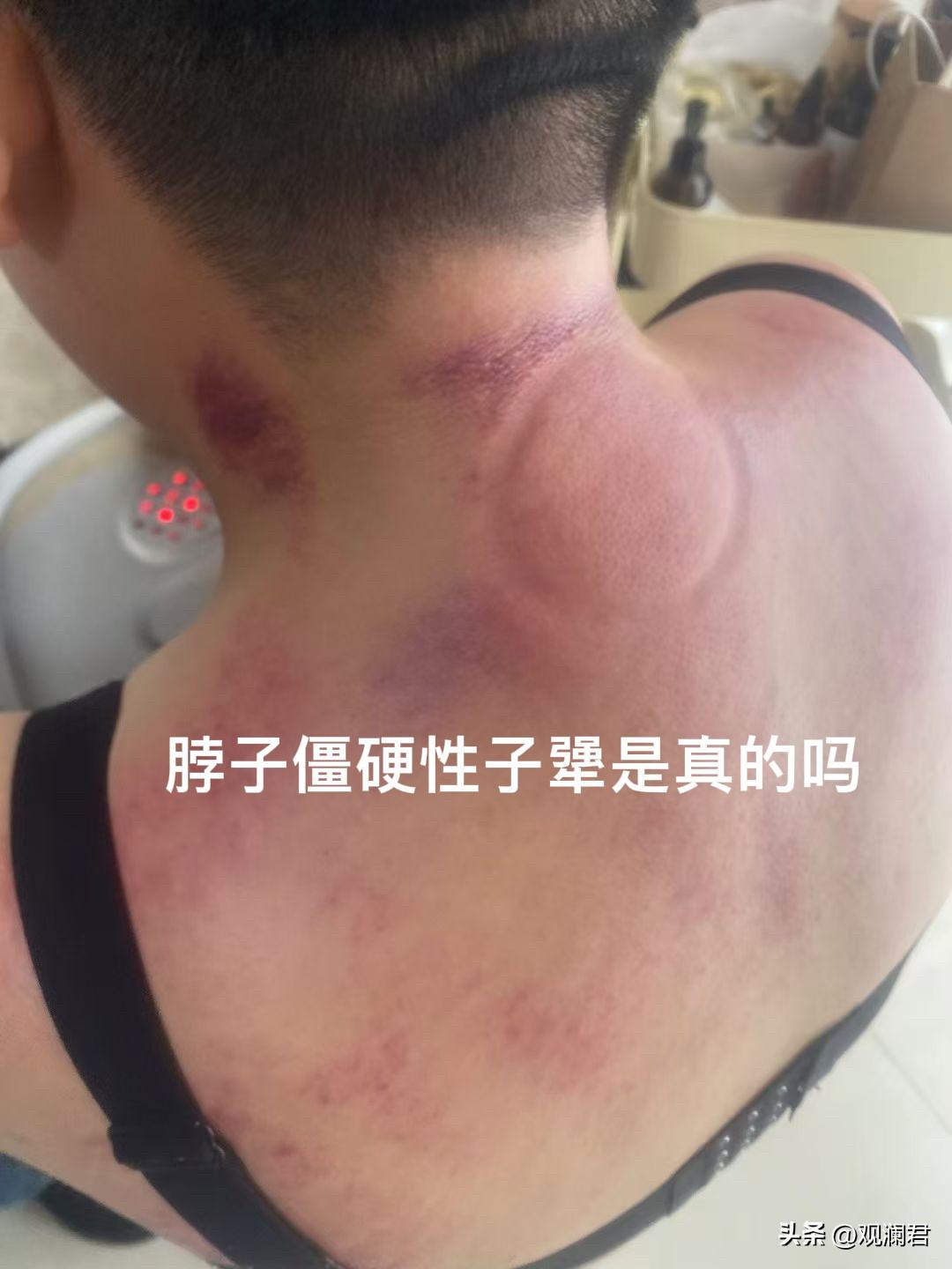 脖子僵硬性子犟是真的吗？
很多人颈椎不舒服、脖子僵硬，去做理疗时听了理疗师的一番