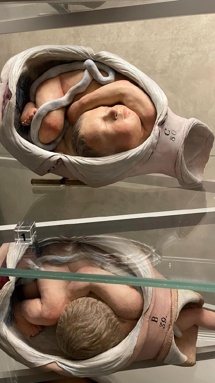 胎位不正 好吓人啊 