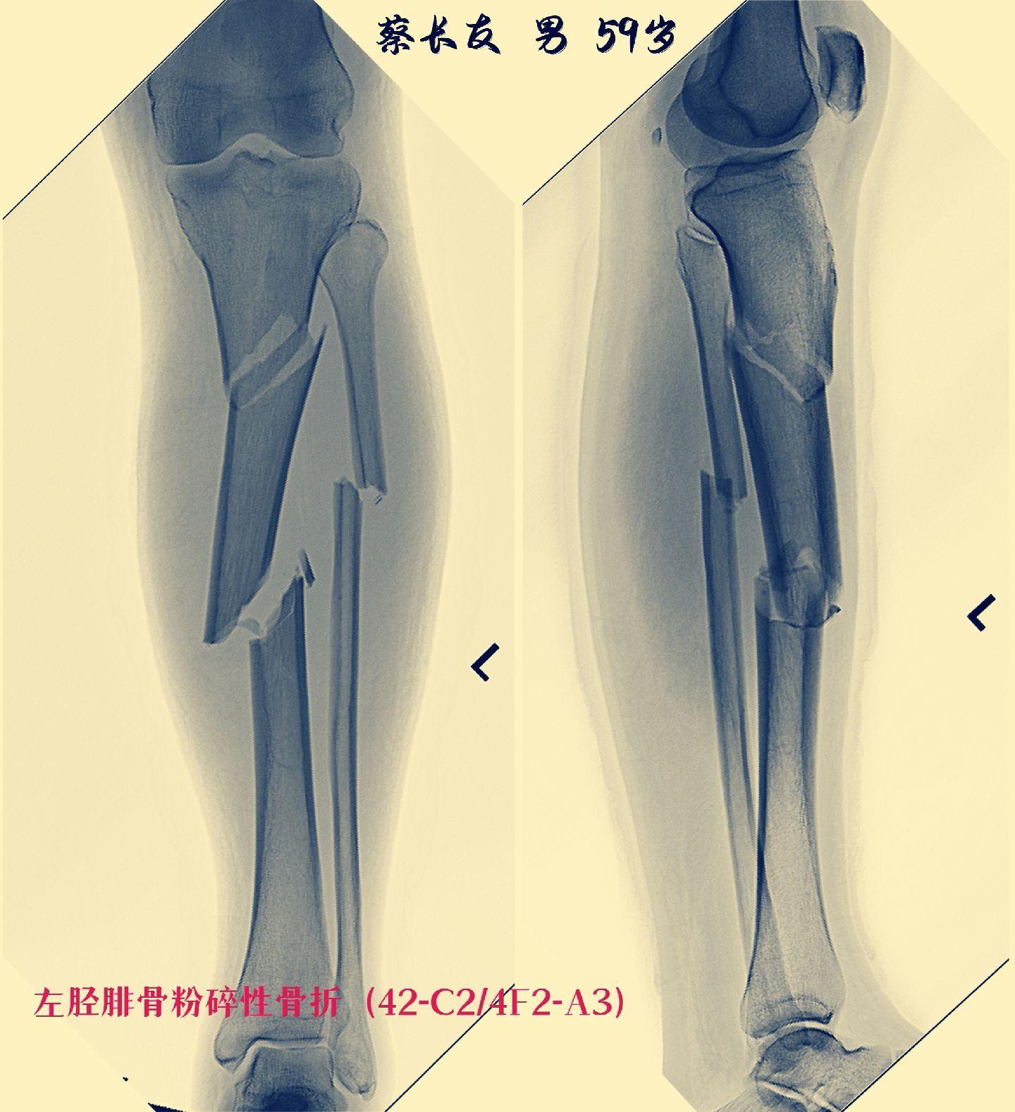 两例车祸外伤导致的相似的42-C型胫骨多段骨折，均采用半伸膝位髌旁入路施行骨折闭合复位髓内钉内固定术，在最大程度保护软组织的前提下，结合经皮捆绑及阻挡钉技术，尽量追求实现骨折的理想复位！期待患者都能有一个满意的预后！