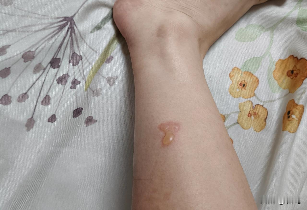 这种水泡应该戳破还是不管它？

昨天这个地方疼，我就随手贴了一止痛膏，然后忘记撕