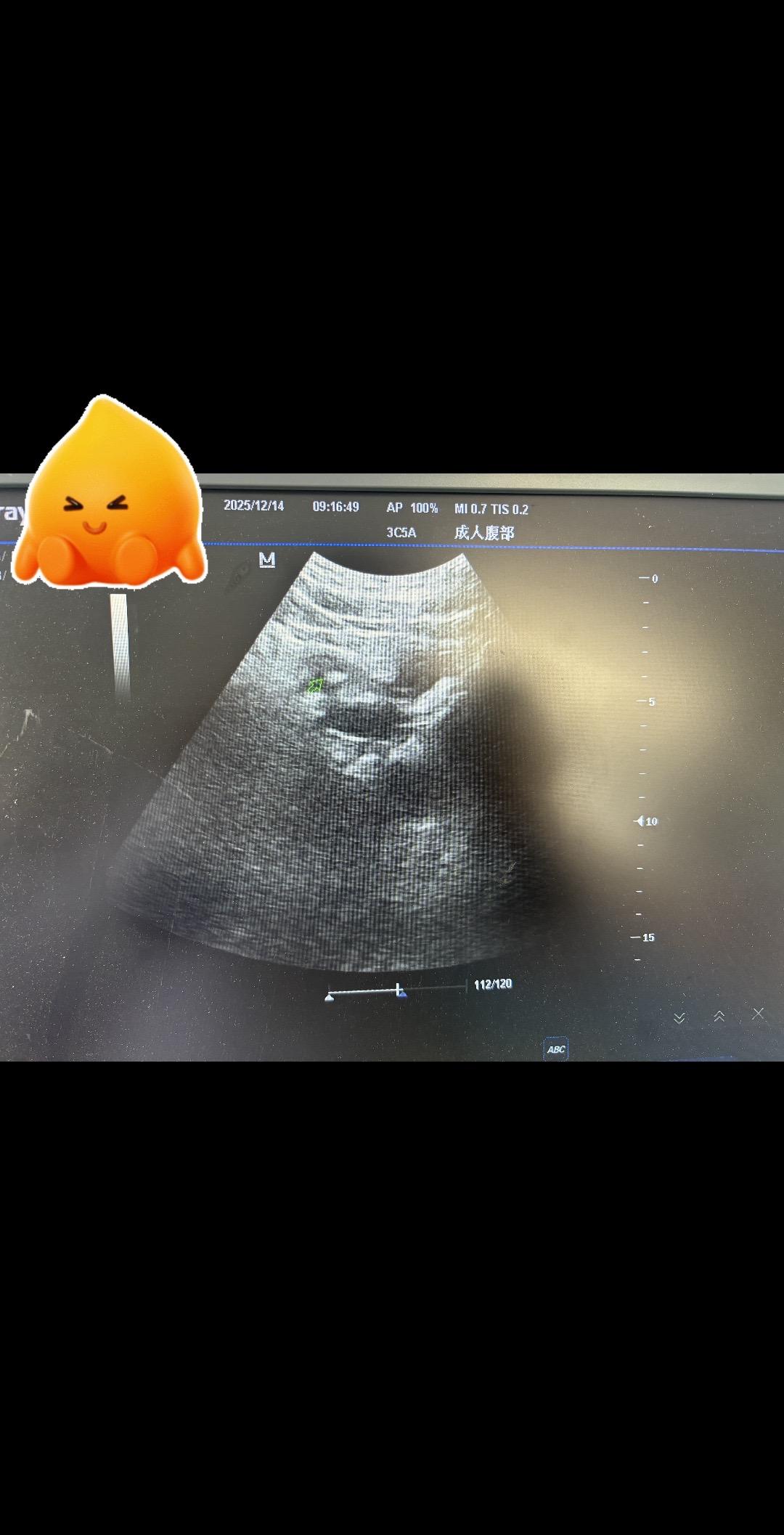 老师们 近膀胱处1cm 12*7结石怎么排出来 必须手术或者碎石吗