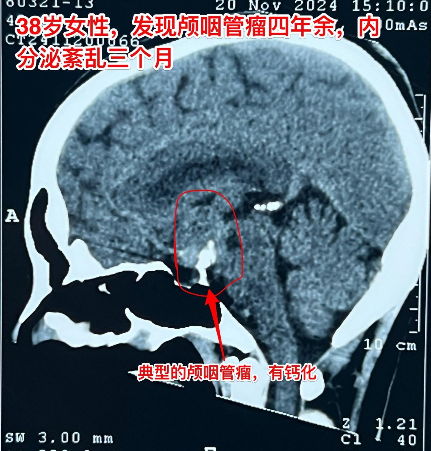 颅咽管瘤等待四年多才作手术，是否合适？偶然发现的颅咽管瘤，病人几乎没有...