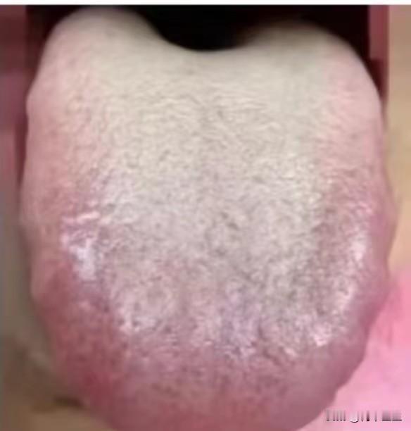 宗筋软，一碰就倒？这个样子的舌头不是光补就行，还要先去湿热才行；有这样舌象的人，
