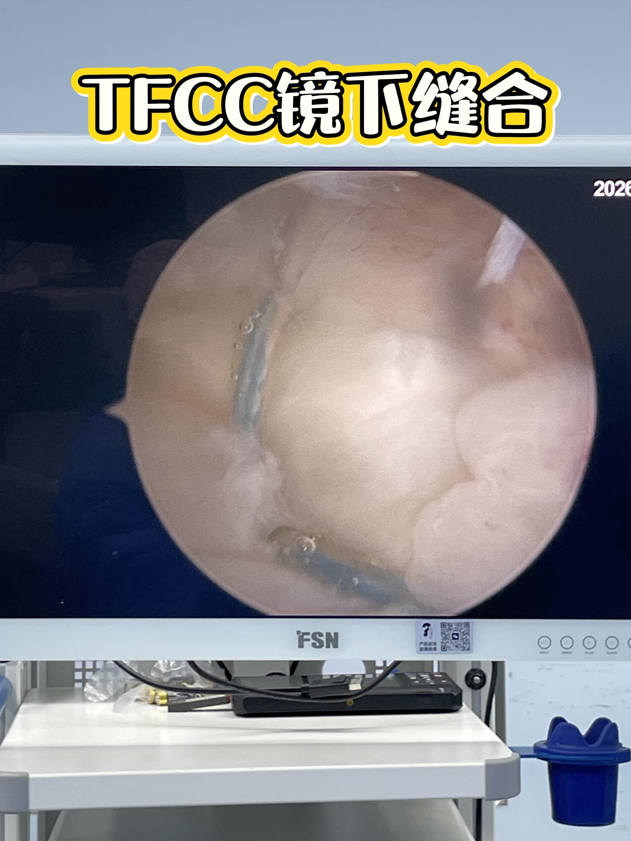 TFCC镜下缝合。很多手腕尺侧痛、拧毛巾无力的根因在这里——三角纤维软...