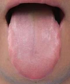周身困乏、头脸油脂旺盛伴随精力下滑，辨证脾虚湿盛调理思路







最近一位