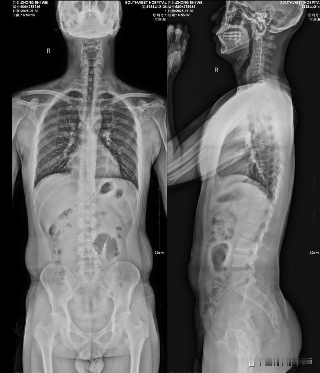 股骨头坏死喝中药调理能好吗股骨头坏死喝中药如果辩证用药正确会有一定的作用。但是中