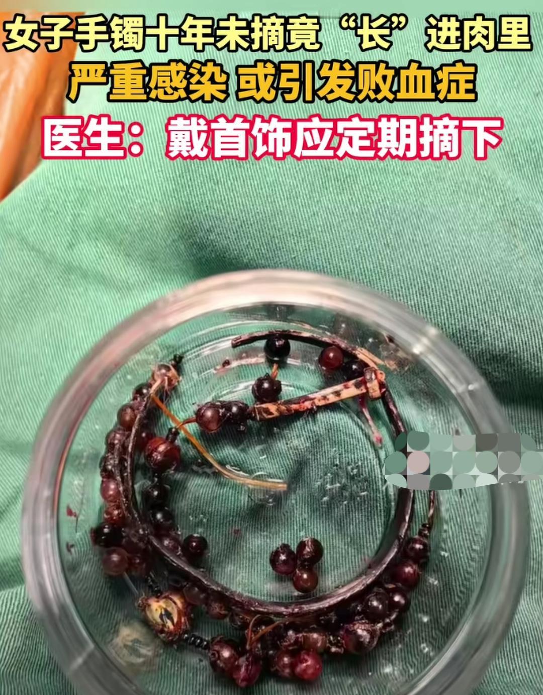 戴手镯10年竟然得做手术
女子戴手镯10年，没成想竟然长进了肉里，这听着就很疼。