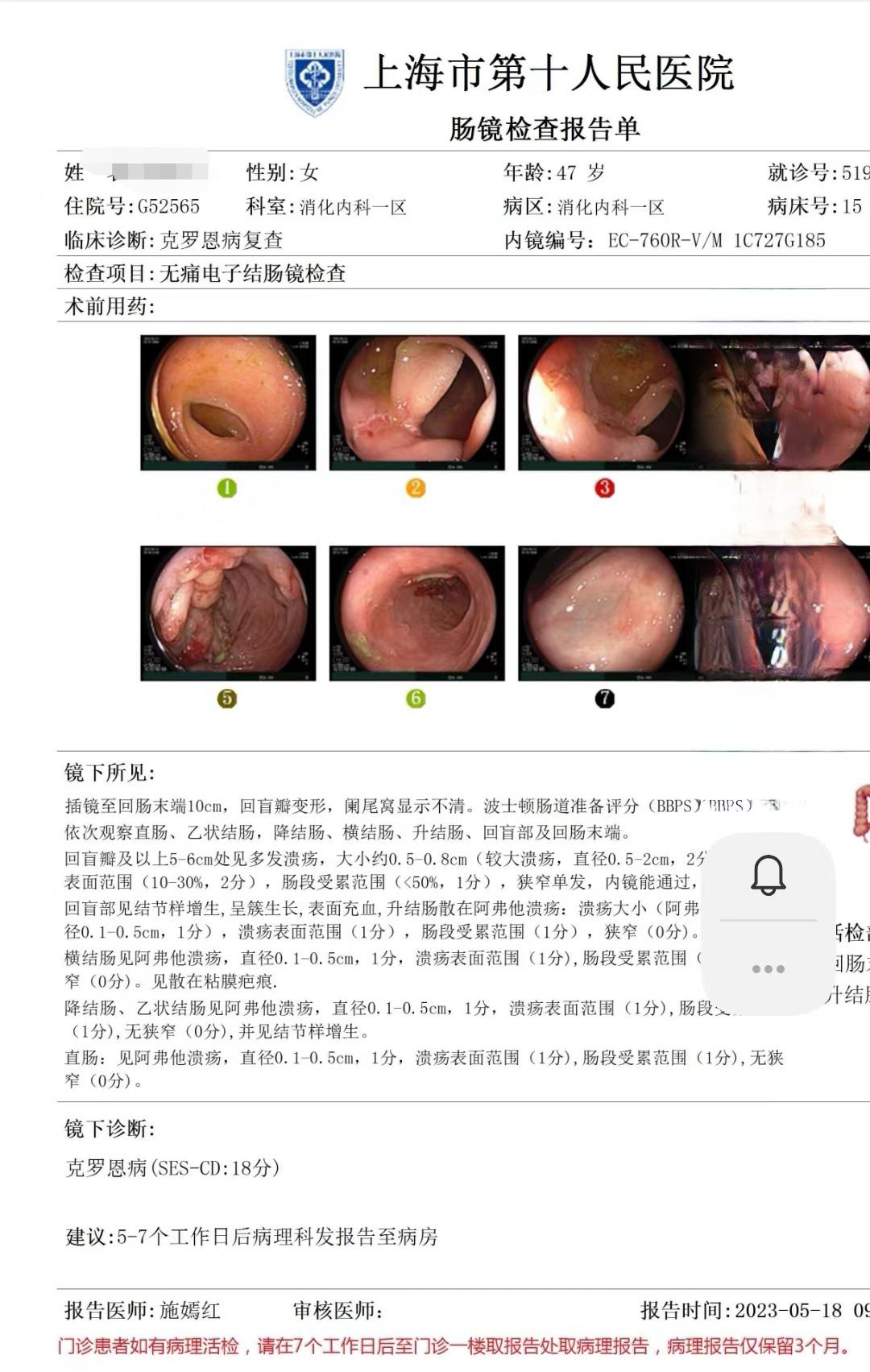 克罗恩病患者疗效不佳必须优化治疗方案。 1.患者优化治疗后，肠镜溃疡消...