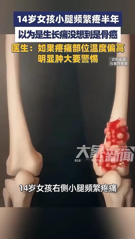 河南郑州，一女孩小腿频繁疼痛，家长以为是生长痛，没当回事，没想到半年也没减轻，甚
