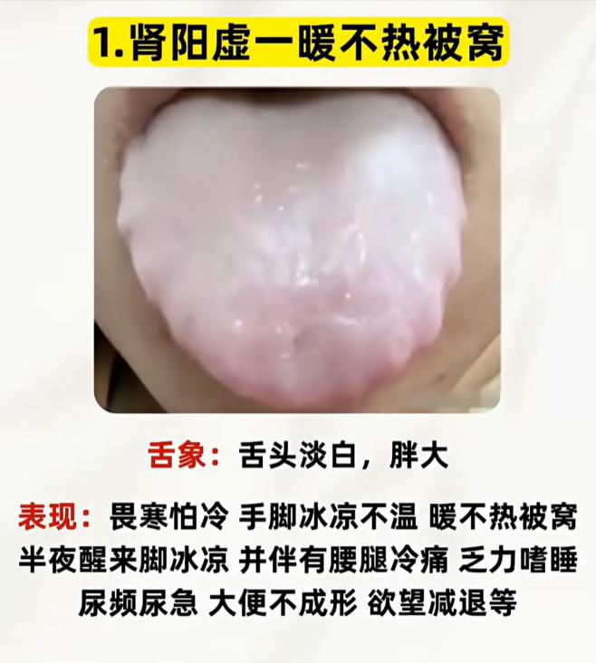 三类肾虚舌象区分，从睡眠症状辨别肾脏亏虚