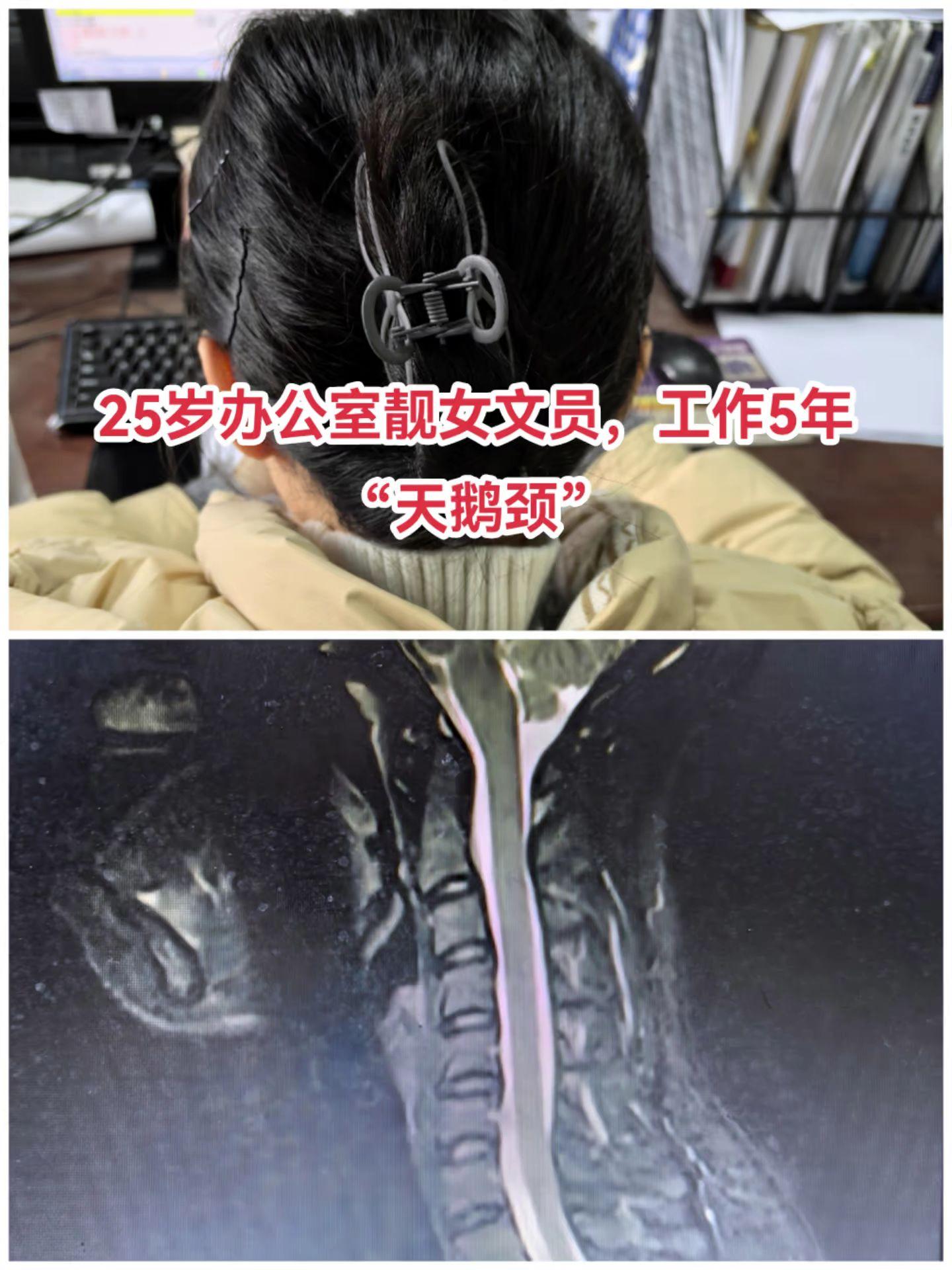 长时间颈部不良姿势（电脑操作、手机等），久坐少动，缺乏必要的锻炼，颈部...