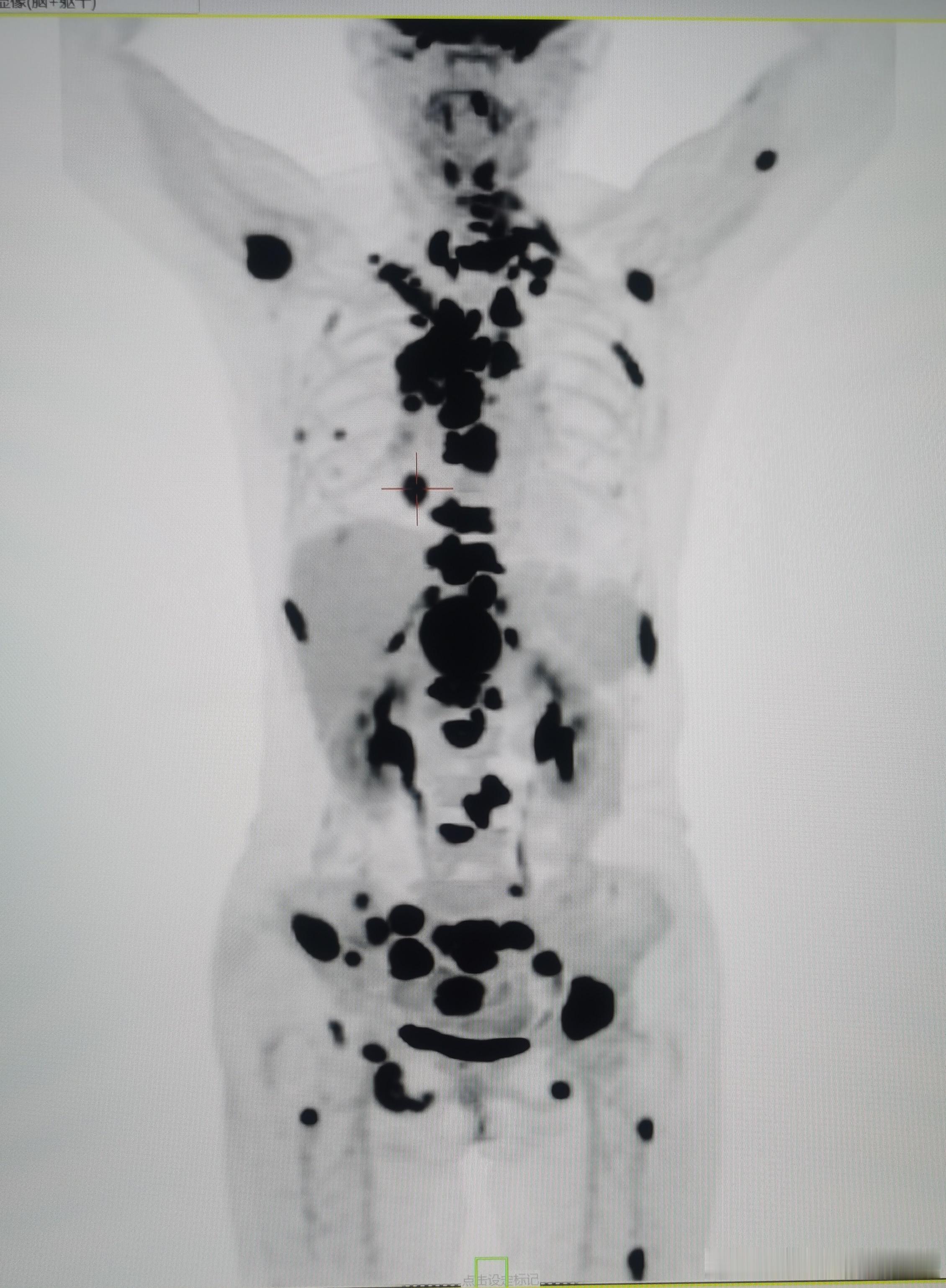 为什么非要等到肺癌全身转移才想到做PET/CT? 