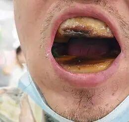 俗话说省着省着、窟窿等着。本想着省钱自己补牙的，结果事情搞大了！
前不久，天津一