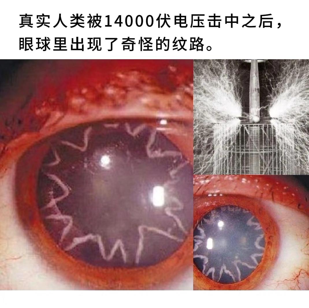 人类被14000伏电压击中之后，眼球里出现了奇怪的纹路。