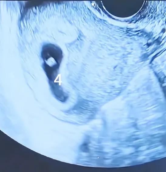 “太离谱了”！自己偷打促排针怀上四胞胎，医生却冷脸下令“必须减掉两个”！江苏淮安