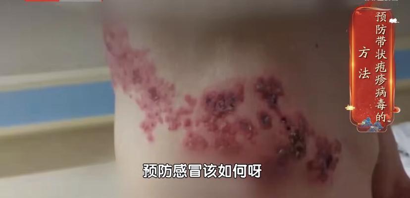 您知道吗?咱们小时候得的水痘，那个病毒可没真离开，而是一直在身体里“装睡”。等咱