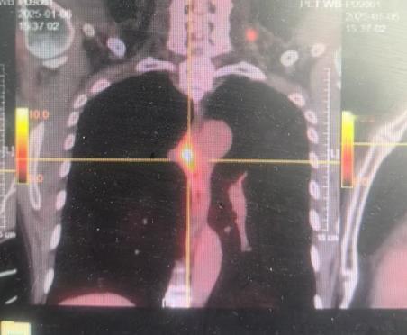 食管癌的典型症状，在医学上称为“进行性吞咽困难”。用通俗的话来解释，就是“越来越