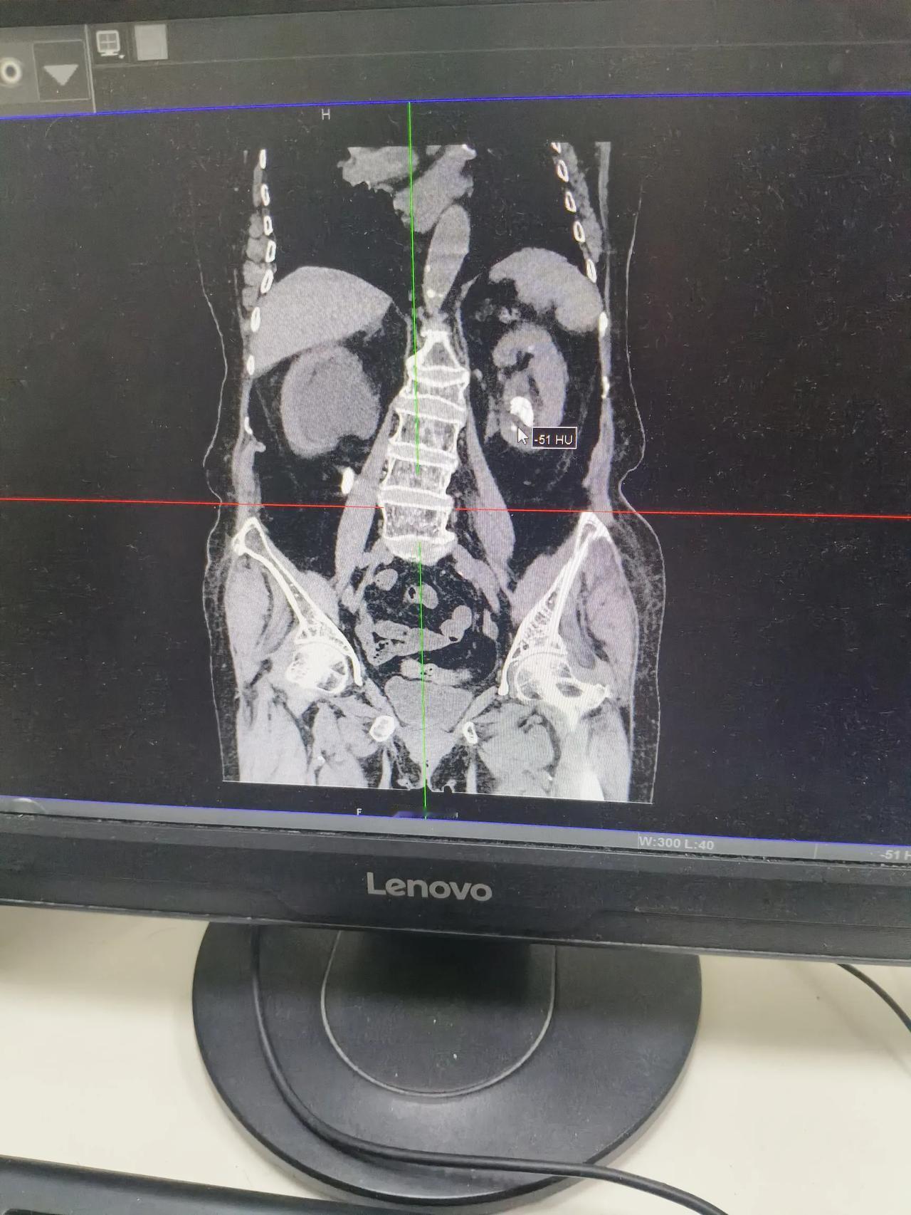 丈母娘93岁了，双肾都患有结石，昨天下午起疼痛，为此我们带她上东方医院挂了急诊。